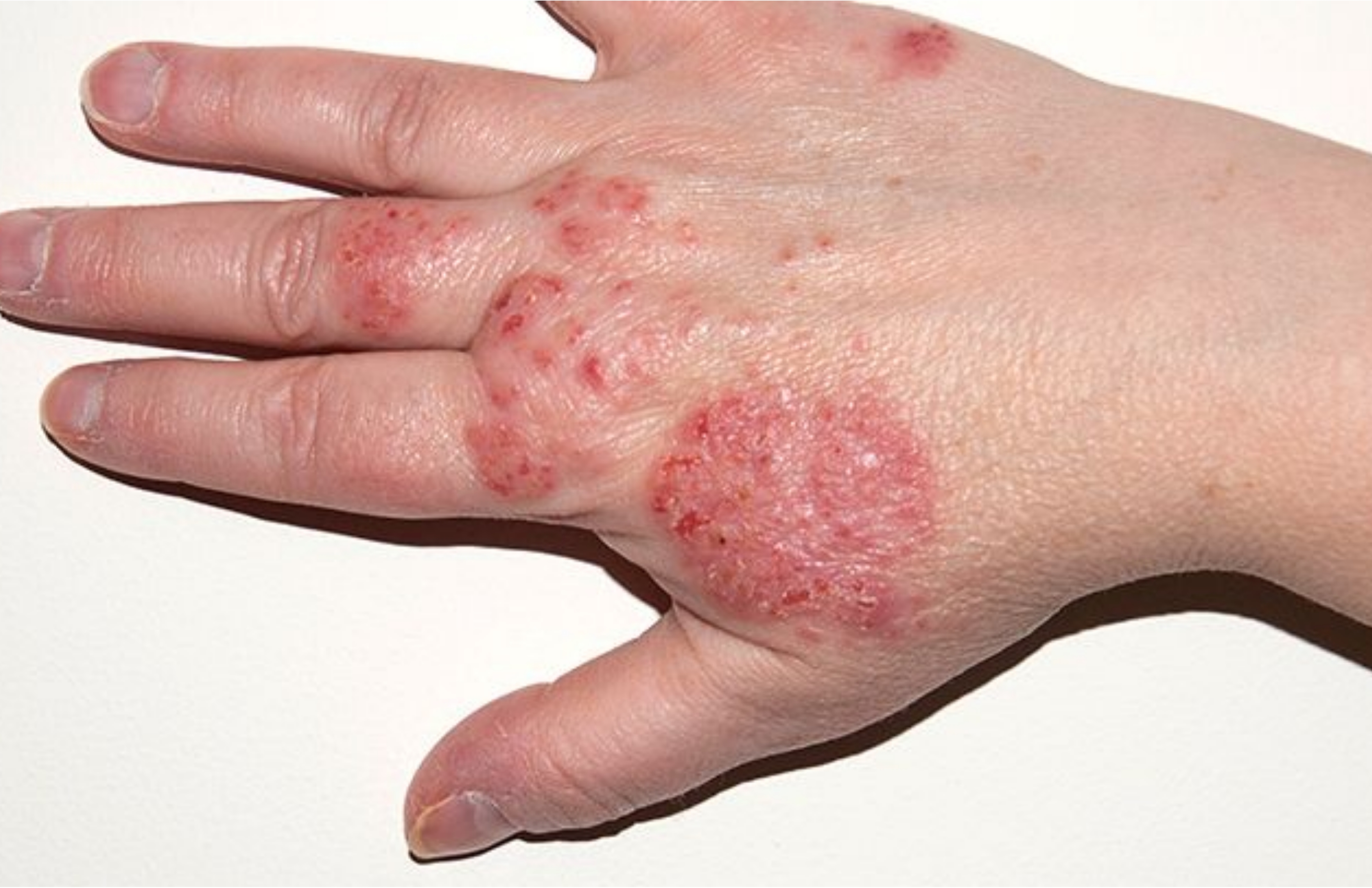Eczema (Atopic Dermatitis)