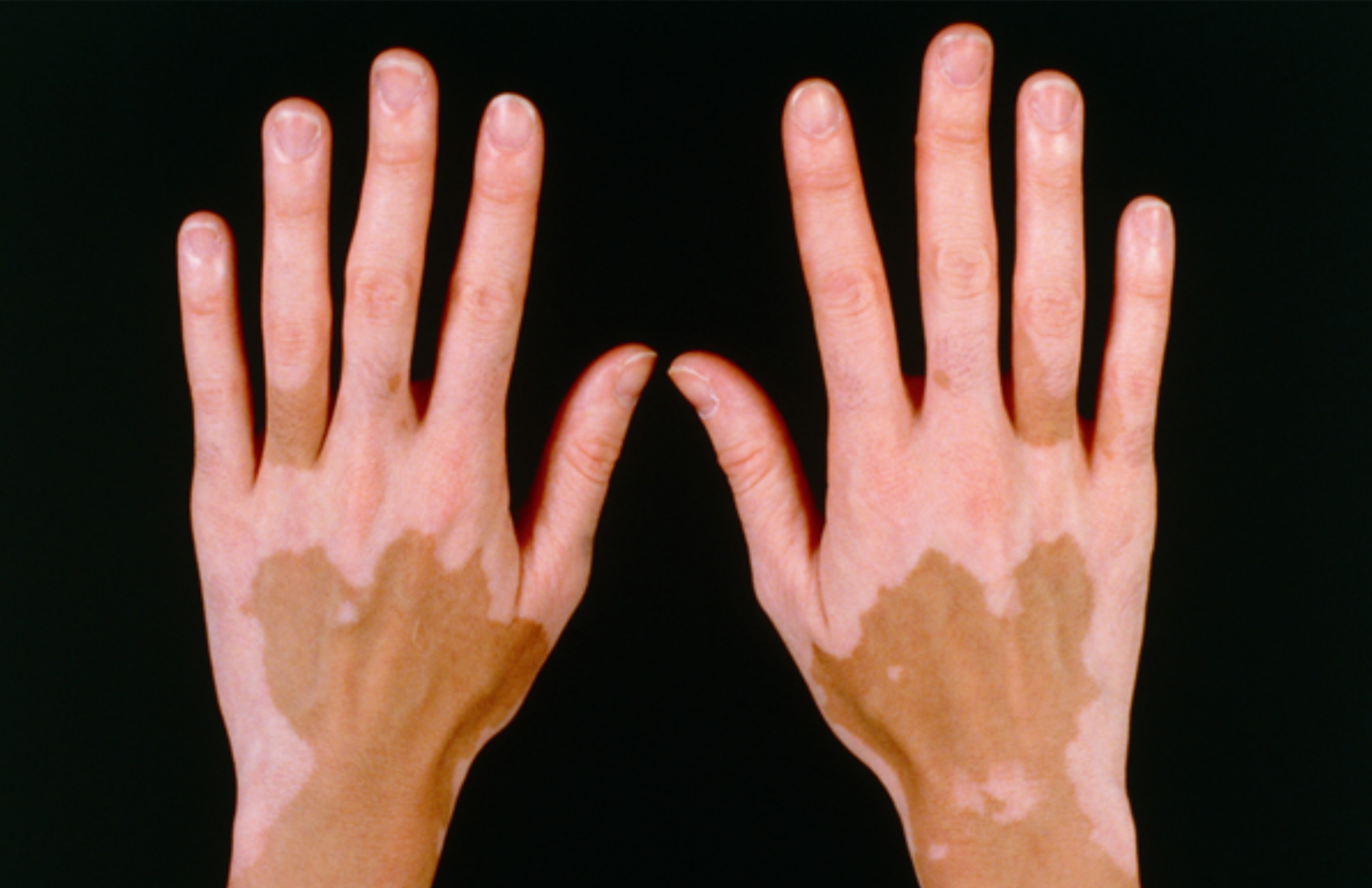 Vitiligo (Leucoderma)