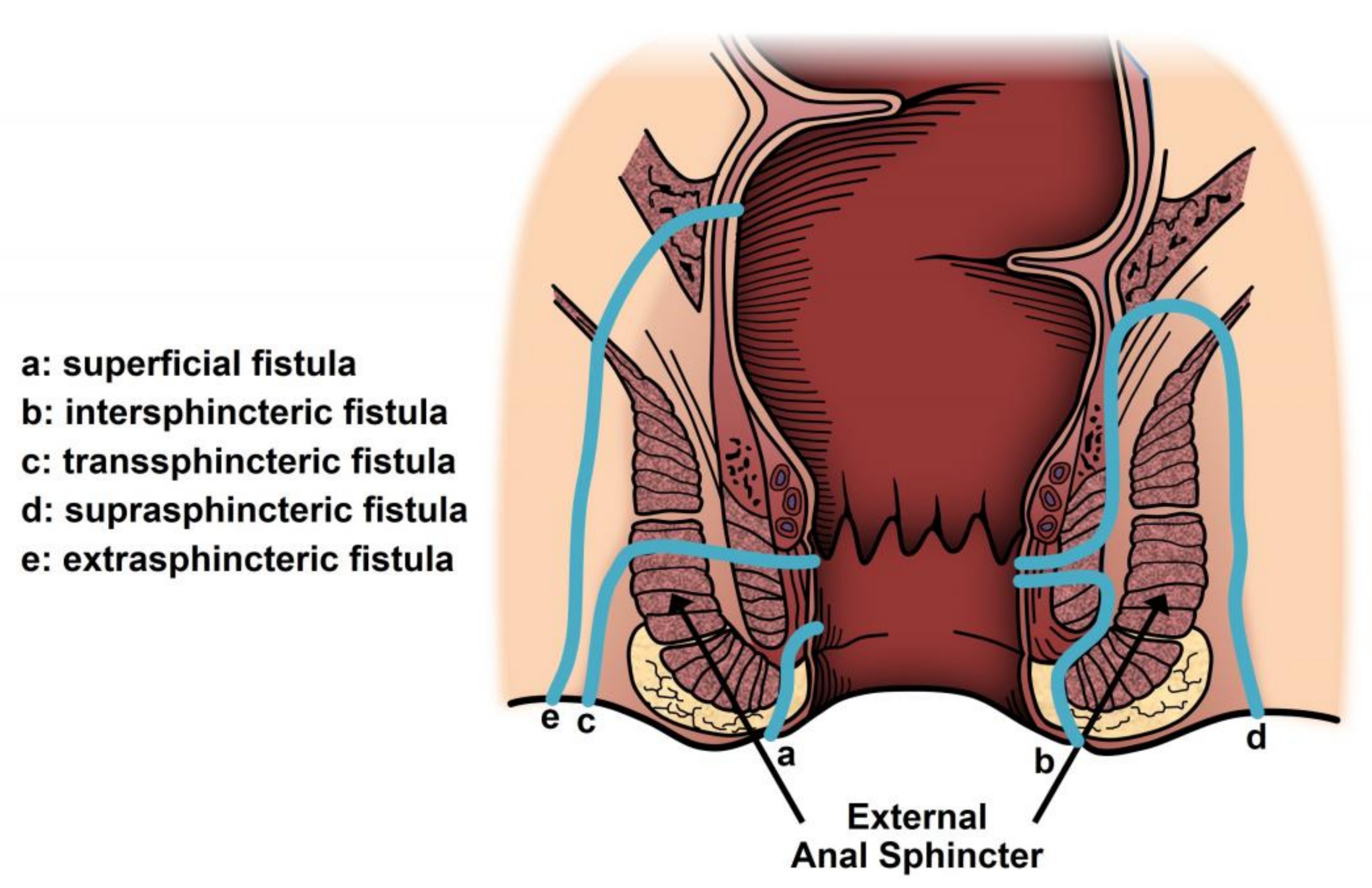 Fistula