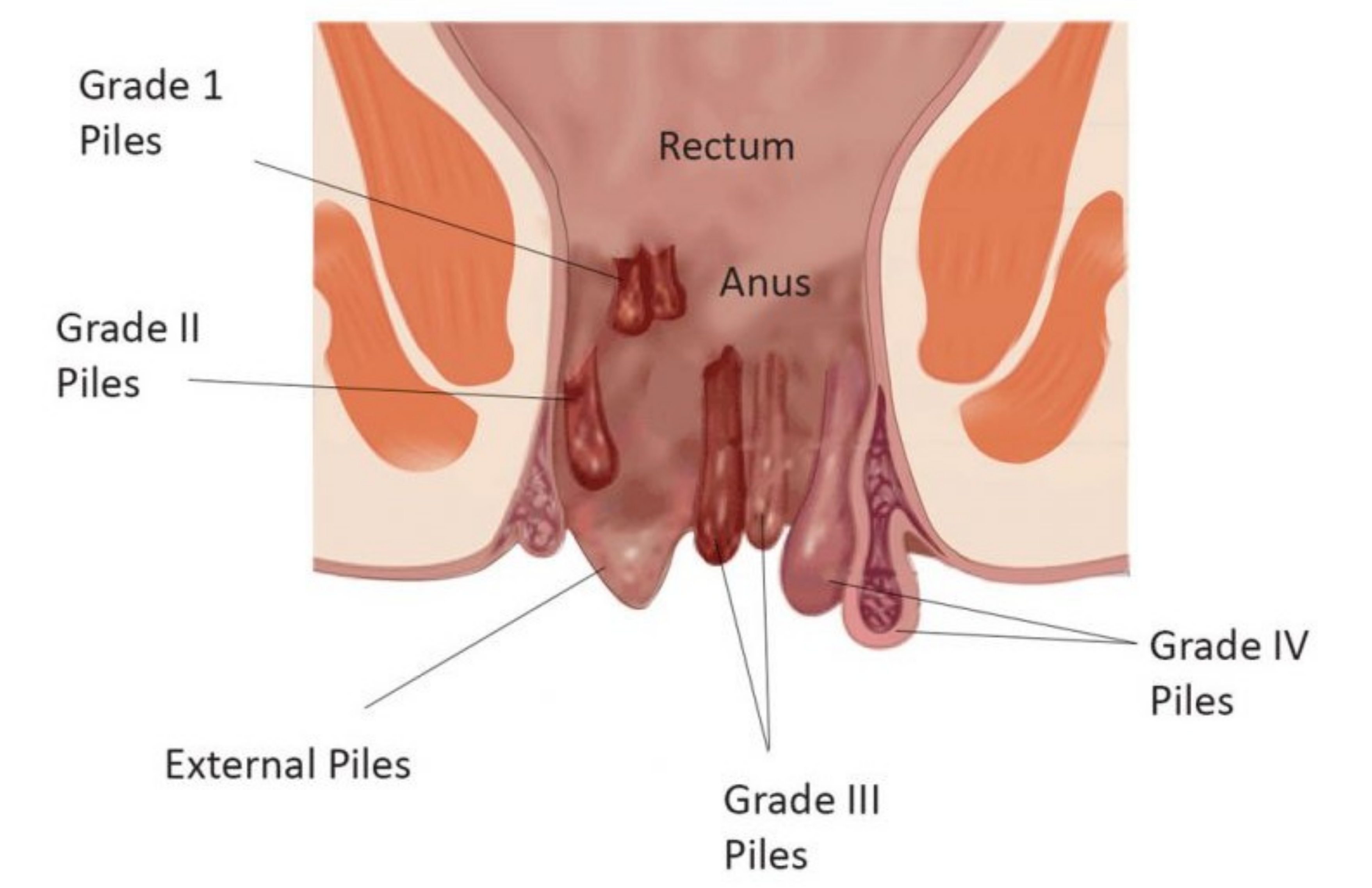 Piles