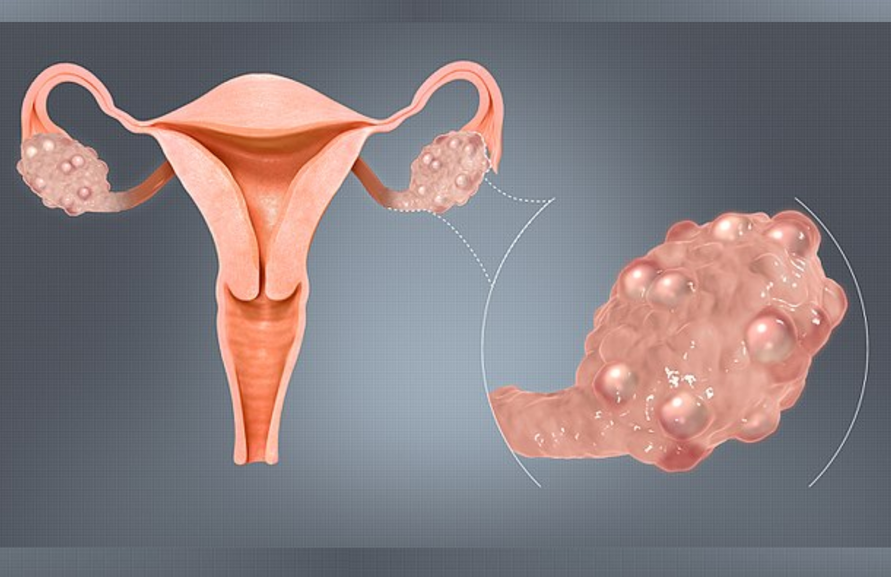 PCOD & PCOS