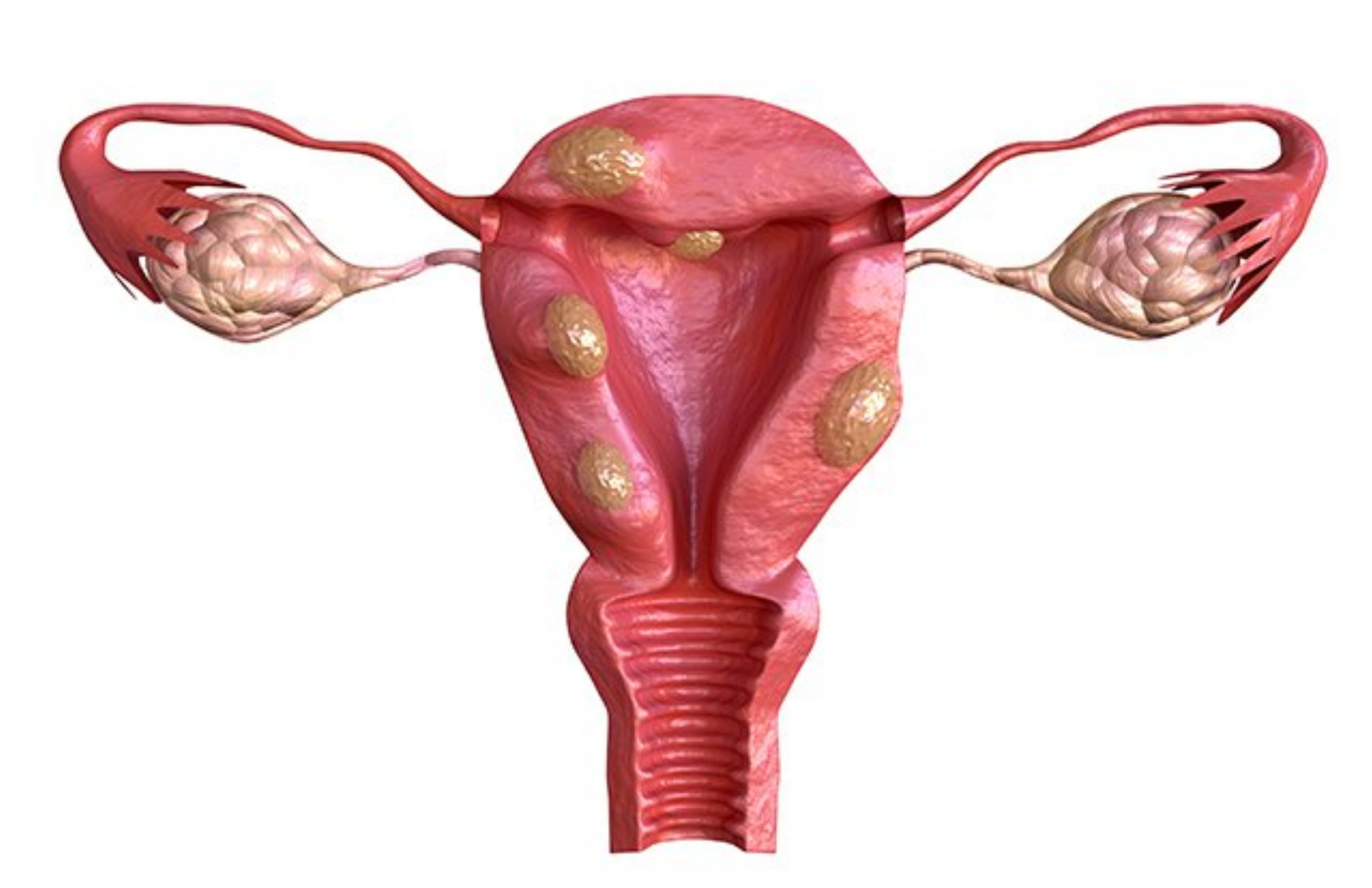 Uterine Fibroids