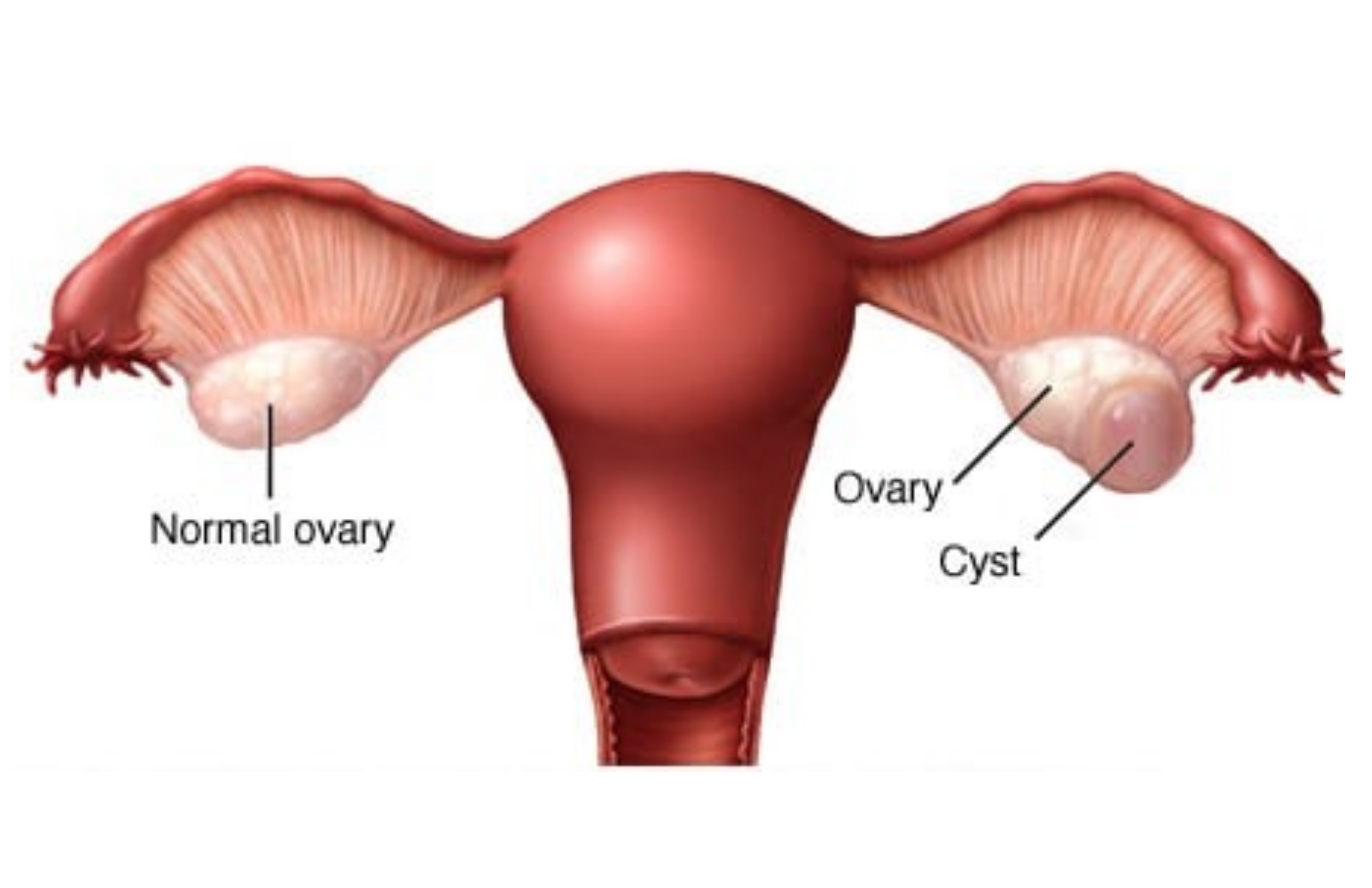 Ovarian Cyst