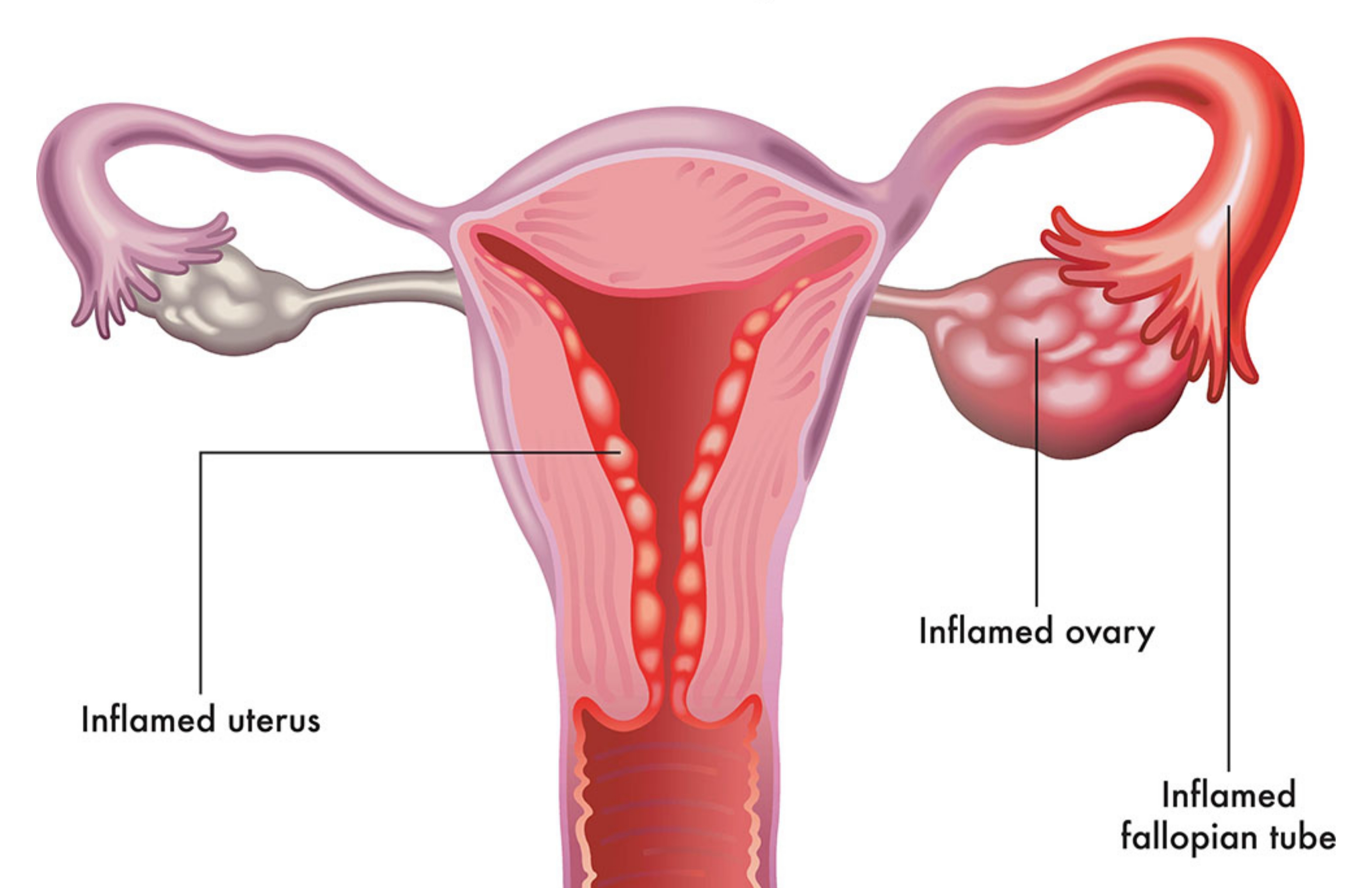 Pelvic Inflammatory Disease (PID)
