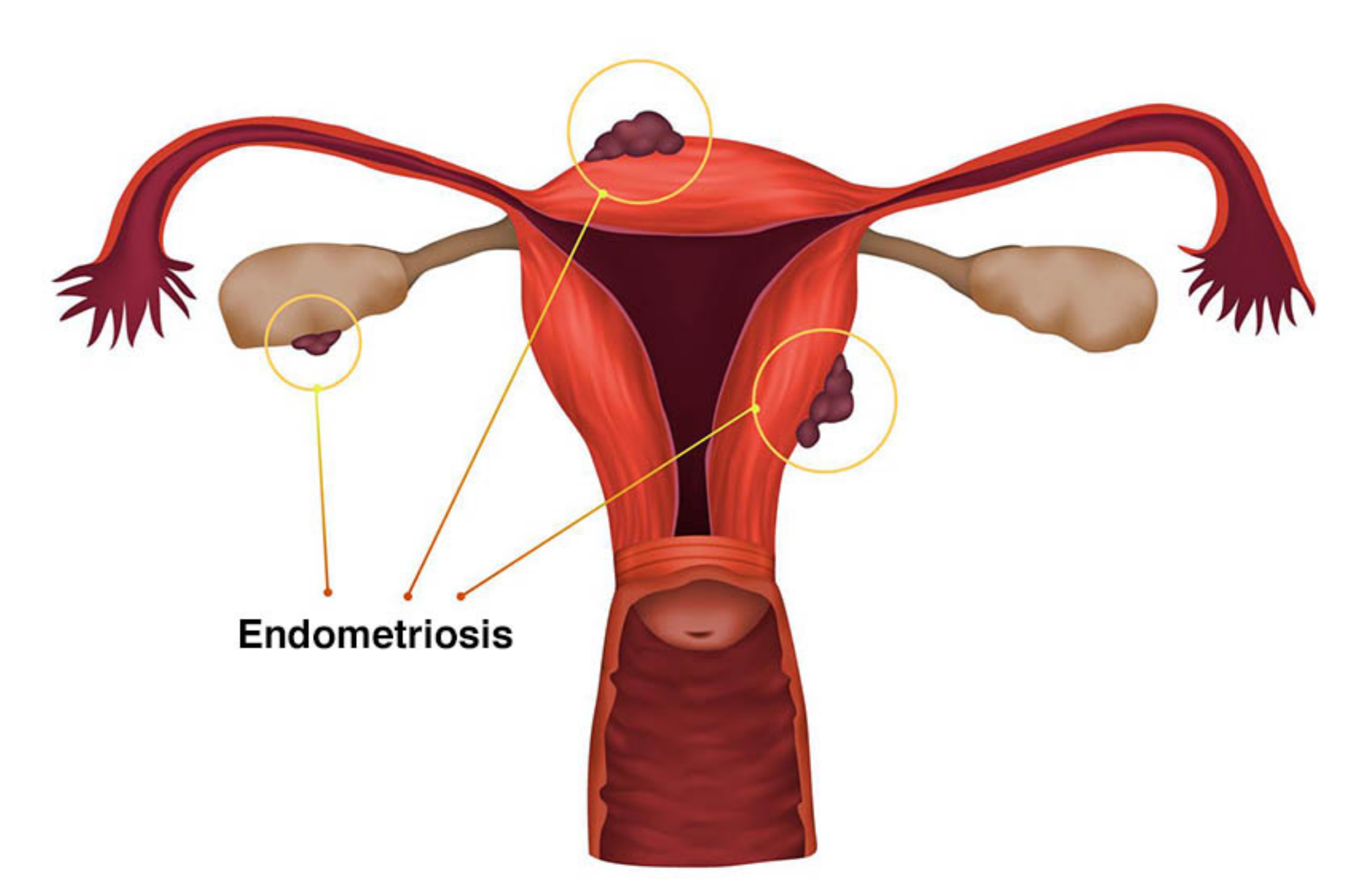 Endometriosis