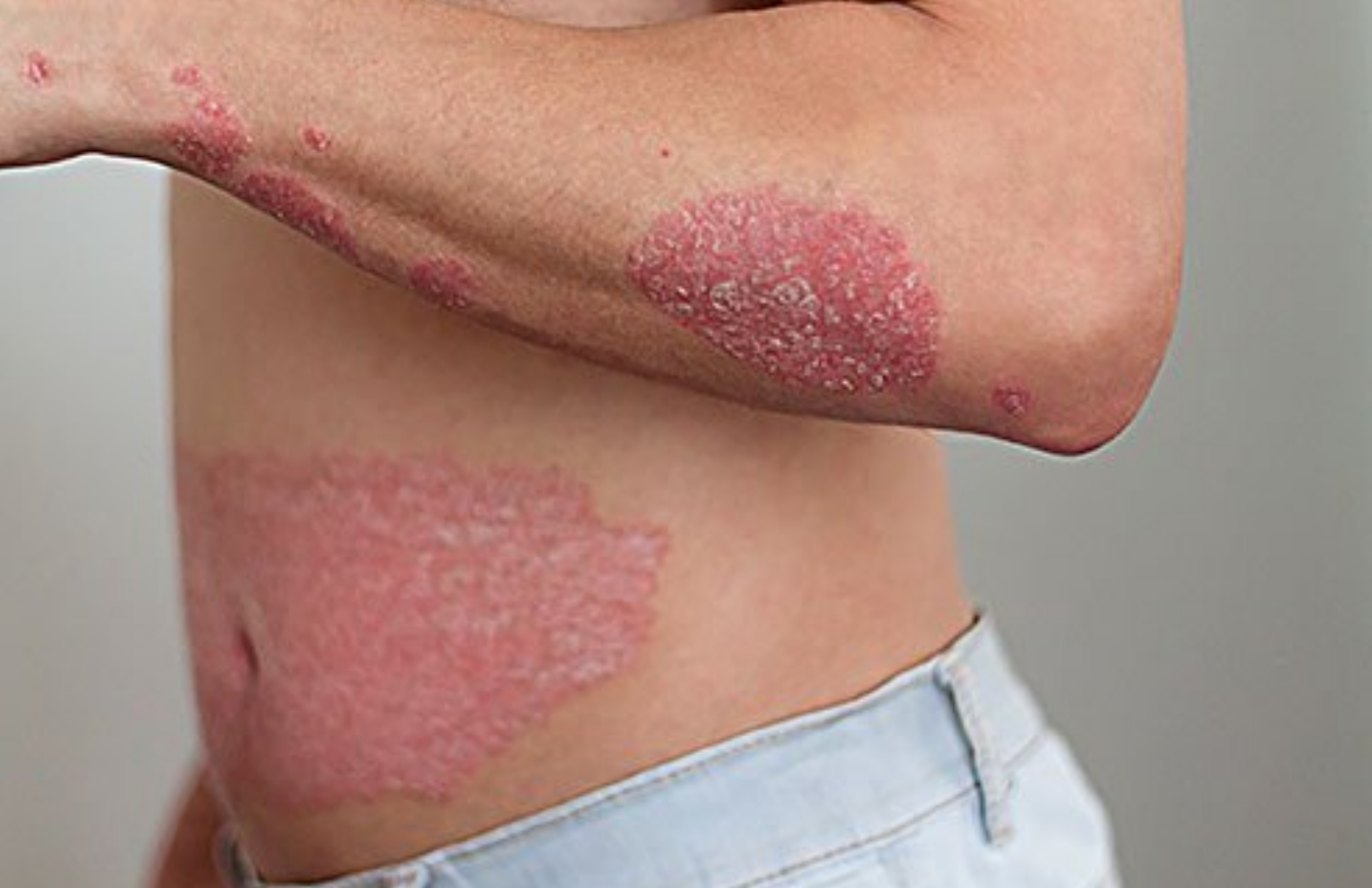 Psoriasis
