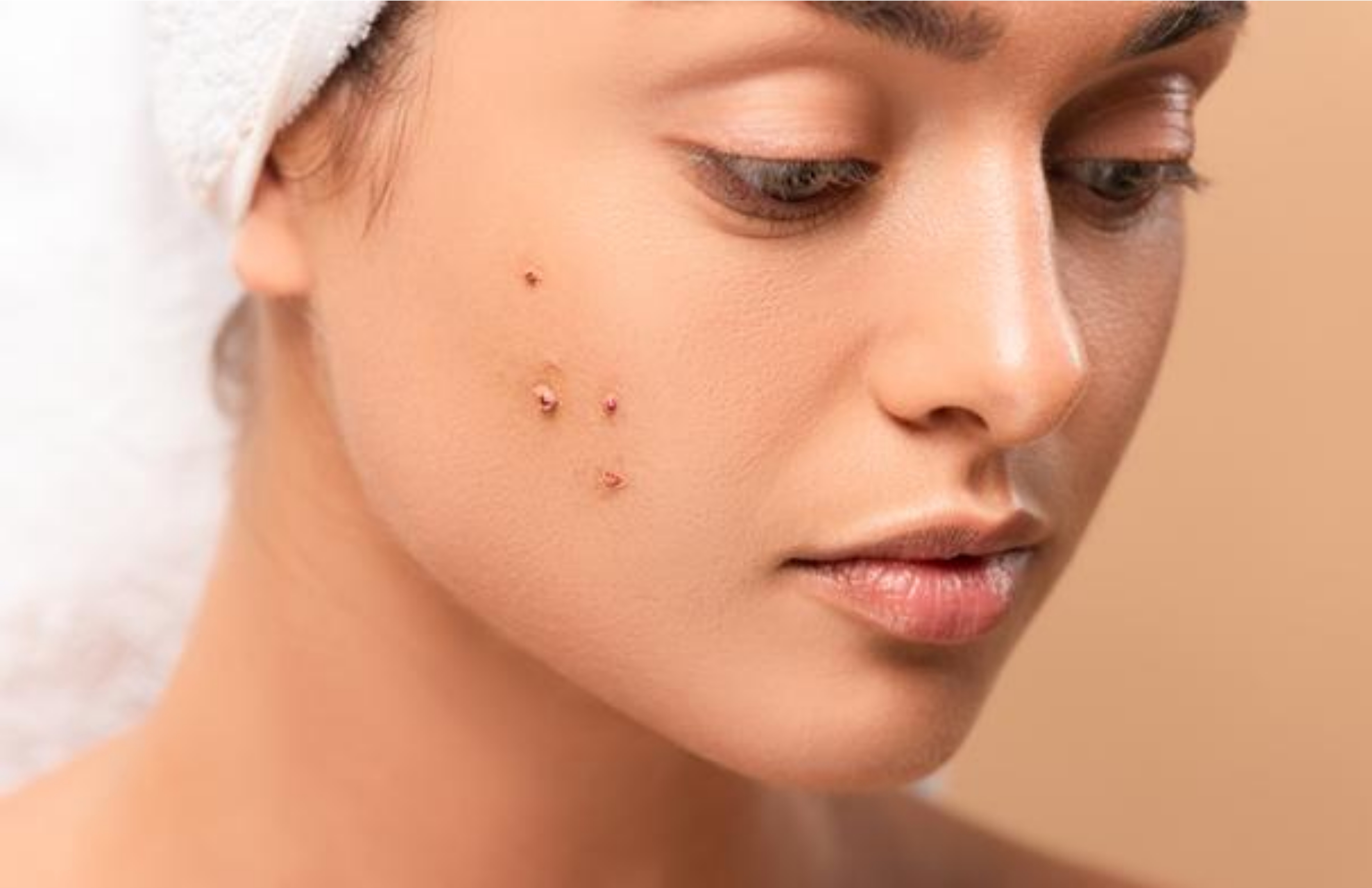 Pimples (Acne)
