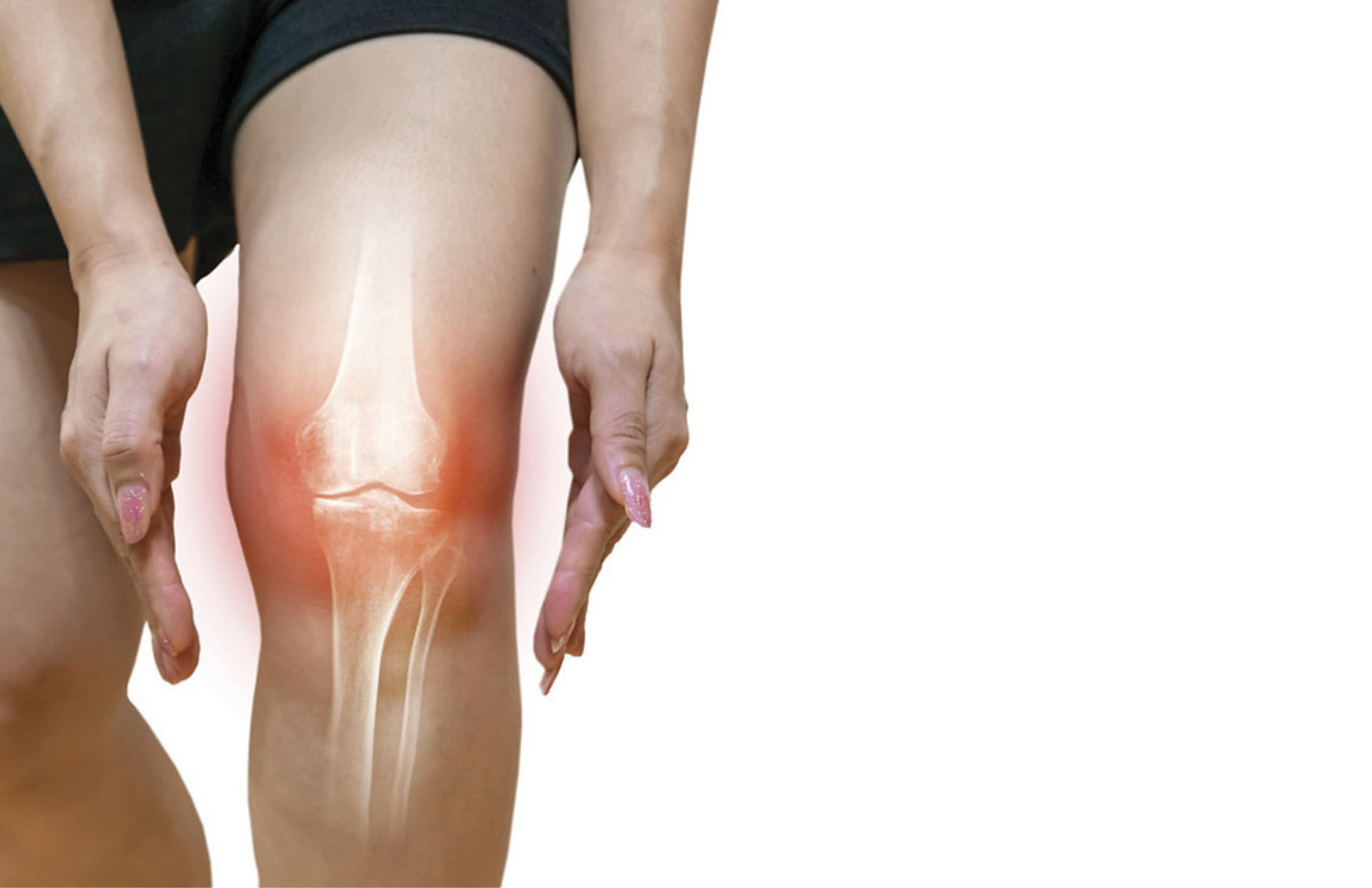 Osteoarthritis