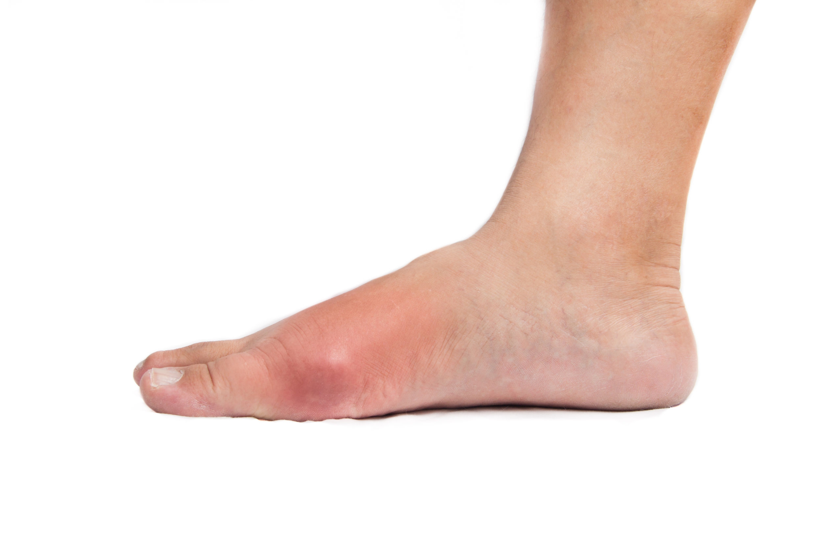 Gout