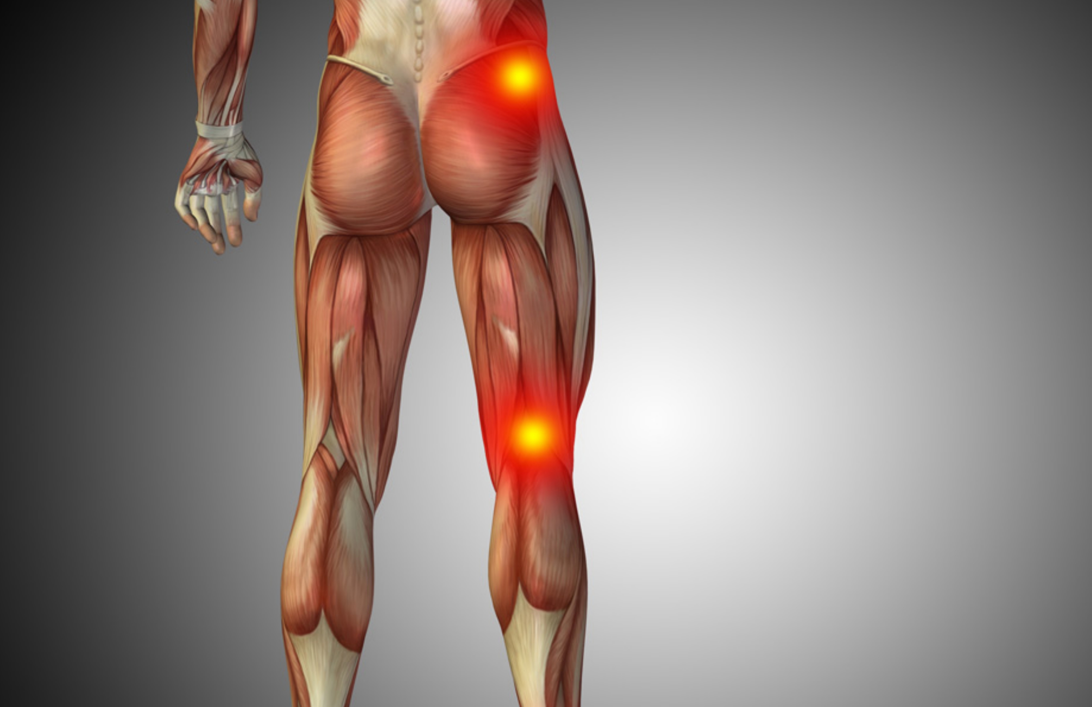Sciatica