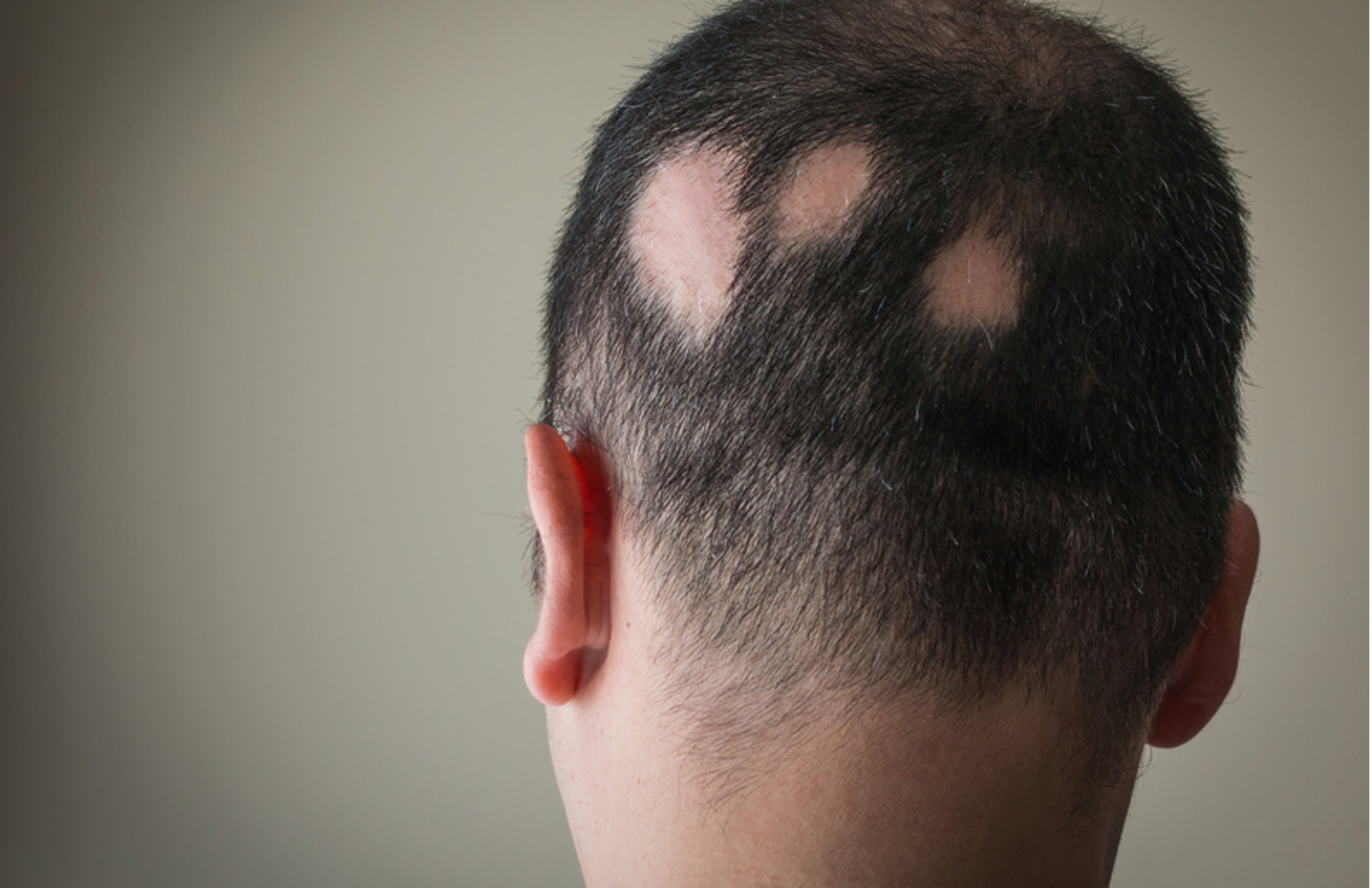Alopecia (Hair Loss)