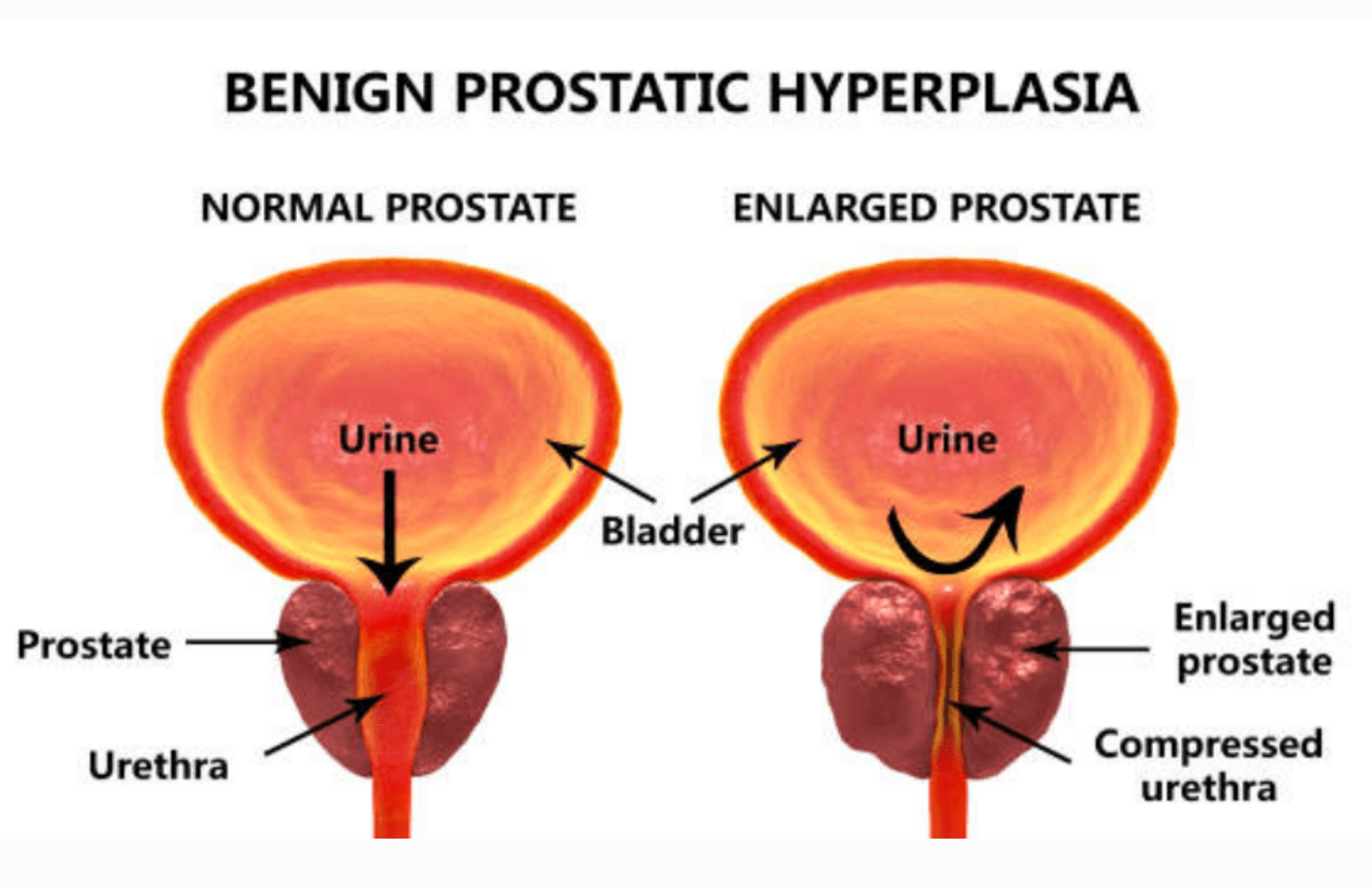 Enlarged Prostate ( BPH )