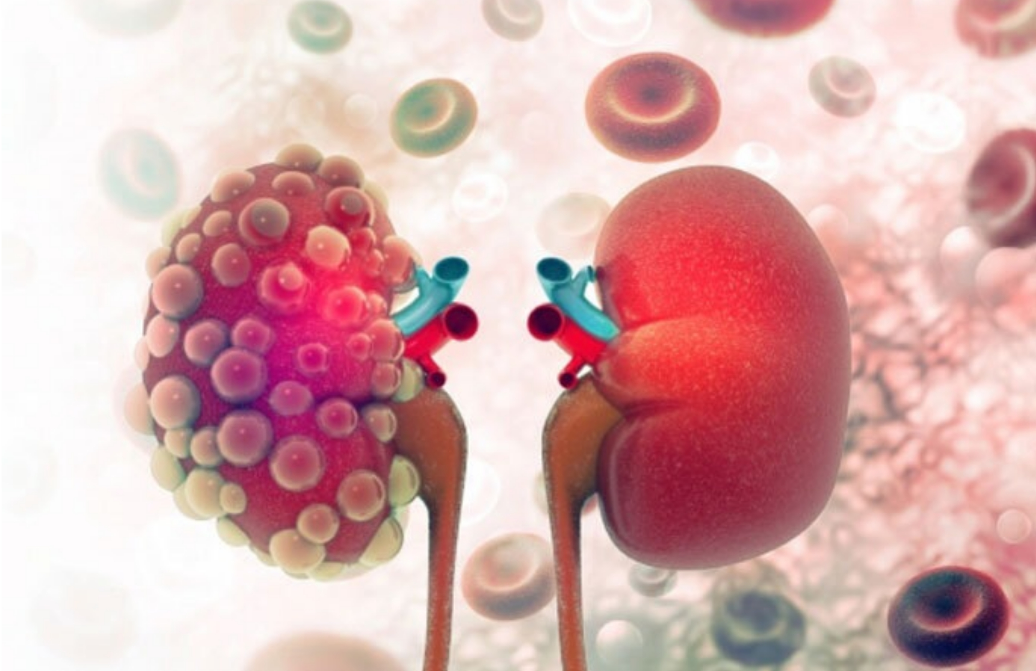 Polycystic Kidney Disease (PKD)