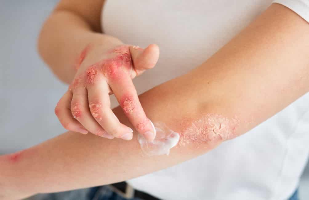 Skin Diseases